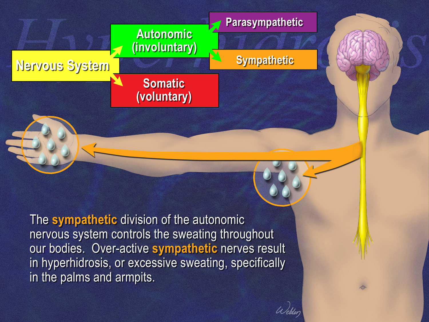 hyperhidrosis surgery