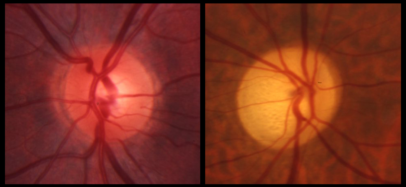 The image on the left shows a normal optic nerve with a good blood supply that tints the photo red. The photo on the right is typical of optic atrophy. Two few cells form and the blood supply is much less. Photo courtesy of Dr. Richard Lewis. 
