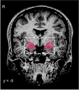 A brain scan taken while mothers view babies’ faces. The colored area shows the amygdalae—key brain areas that processes emotion. They are “turned off” when mothers with unresolved trauma view their own babies in distress.