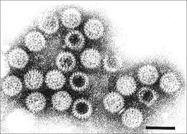 Rotavirus particles visualized by immune electron microscopy in stool filtrate from child with acute gastroenteritis. Courtesy of the federal Centers for Disease Control. 