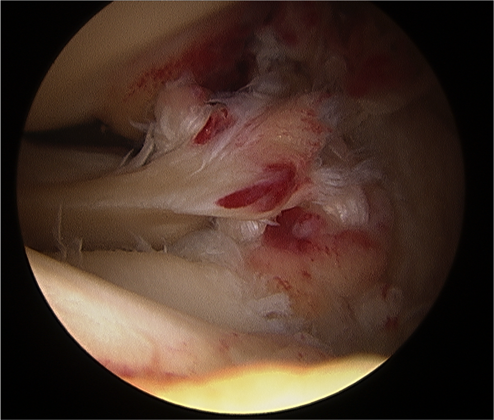Lateral meniscal root avulsion viewed arthroscopically at time of ACL surgery