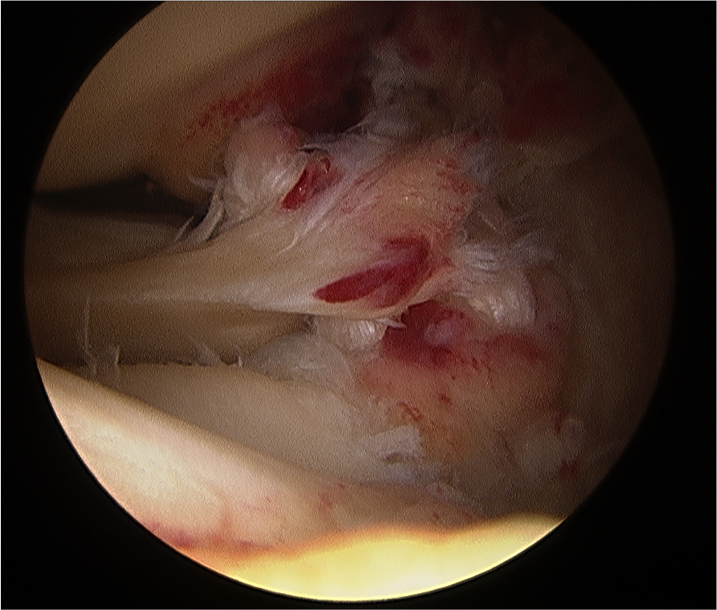 Acl and deals meniscus tear