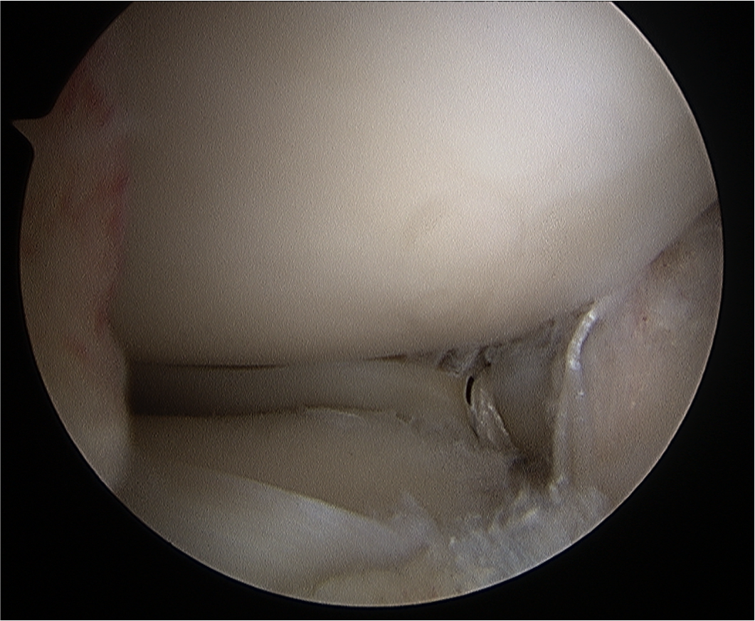 Same case with repaired lateral meniscal root. 