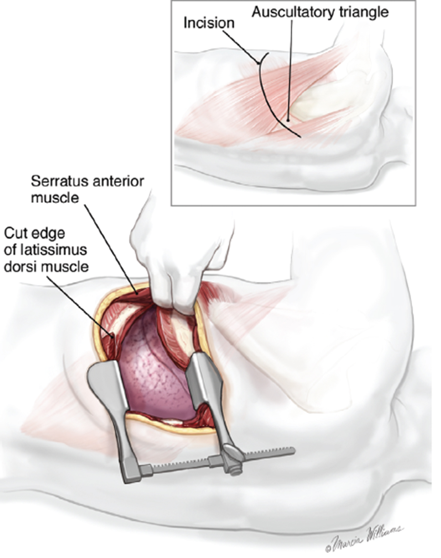 Traditional or open lobectomy. Image by Marcia Williams, courtesy McGraw-Hill Company.