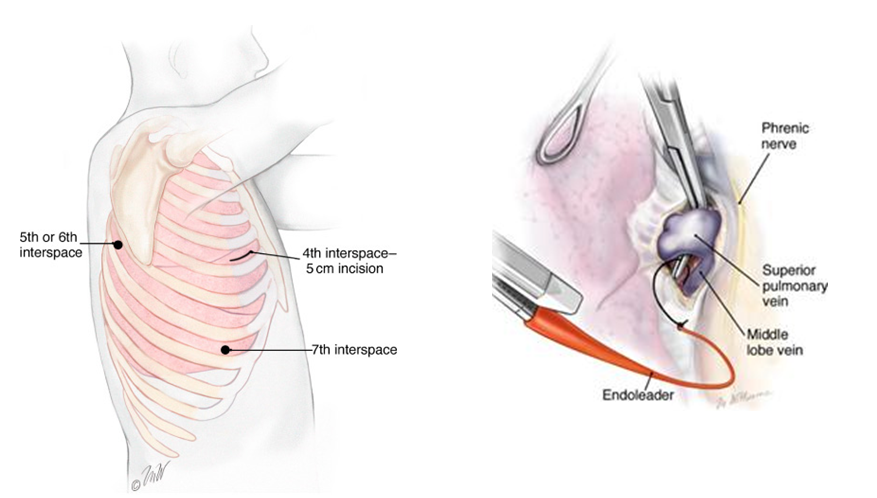Thoracoscopic (VATS) Lobectomy. Image by Marcia Williams, courtesy McGraw-Hill Company.