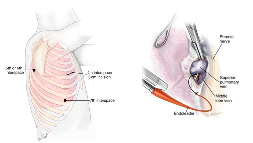 Qanda What You Should Know About Vats Lobectomy Baylor College Of Medicine Blog Network