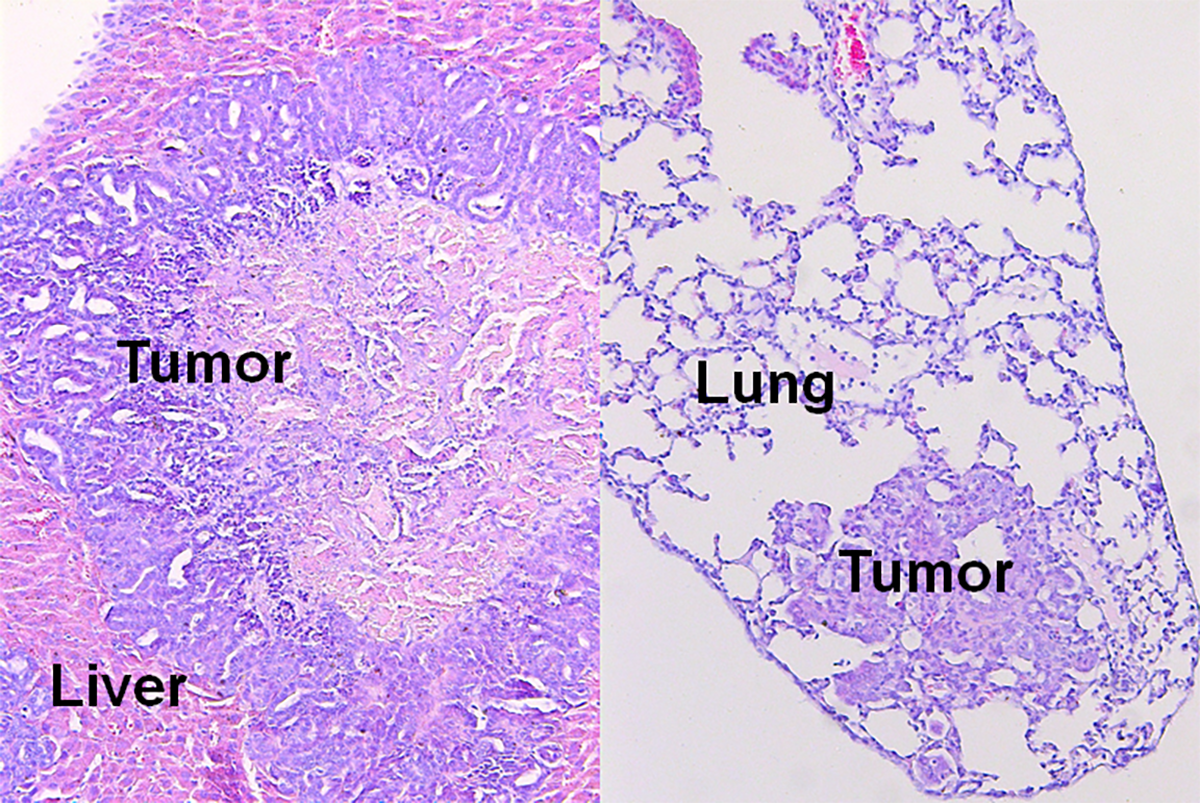 Notch activation promotes metastatic diseases in the Pten-null mouse model. Figure represents that Hematoxylin and eosin staining of the metastatic lesions in liver and lung. (Courtesy of L. Xin and Oh-Joon Kwon.)