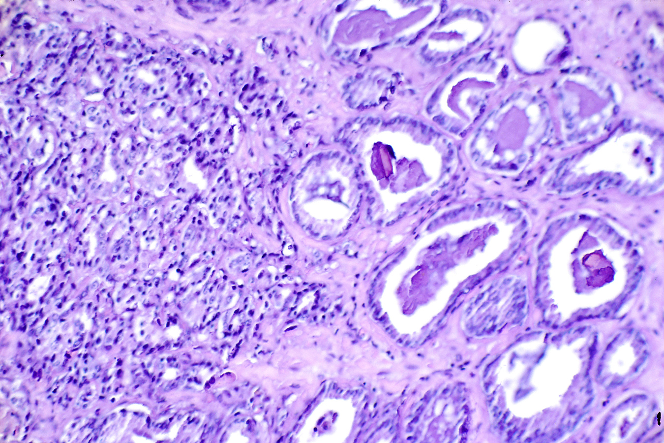 Histological slide (H & E stain at x300) showing prostate cancer. On the right is a somewhat normal Gleason Value of 3 (out of 5) with moderately differentiated cancer. On the left is less normal tissue with a Gleason Value of 4 (out of 5) that is highly undifferentiated. The Gleason score is the sum of the two worst areas of the histological slide. (National Cancer Institute)