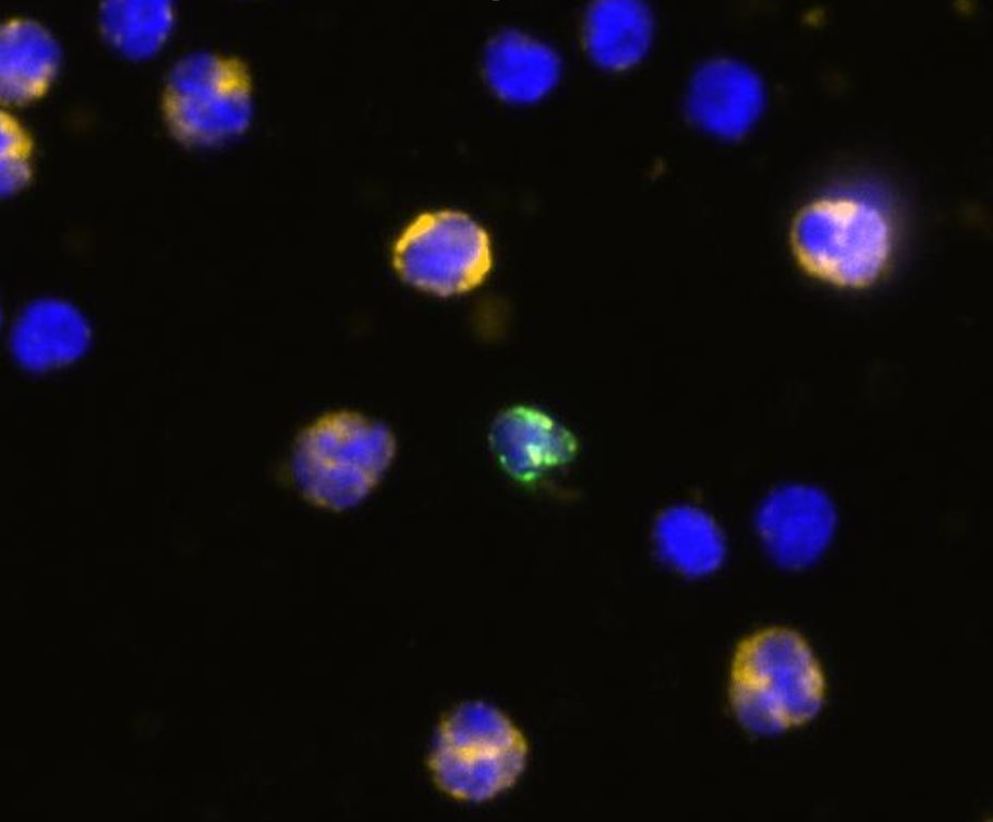 Maternal and fetal cells: Fluorescent staining of cytokeratin (bright green) and other cell surface markers (blue only or blue and orange) allows for differentiation of one fetal cell (bright green) among many maternal cells. Baylor College of Medicine. 