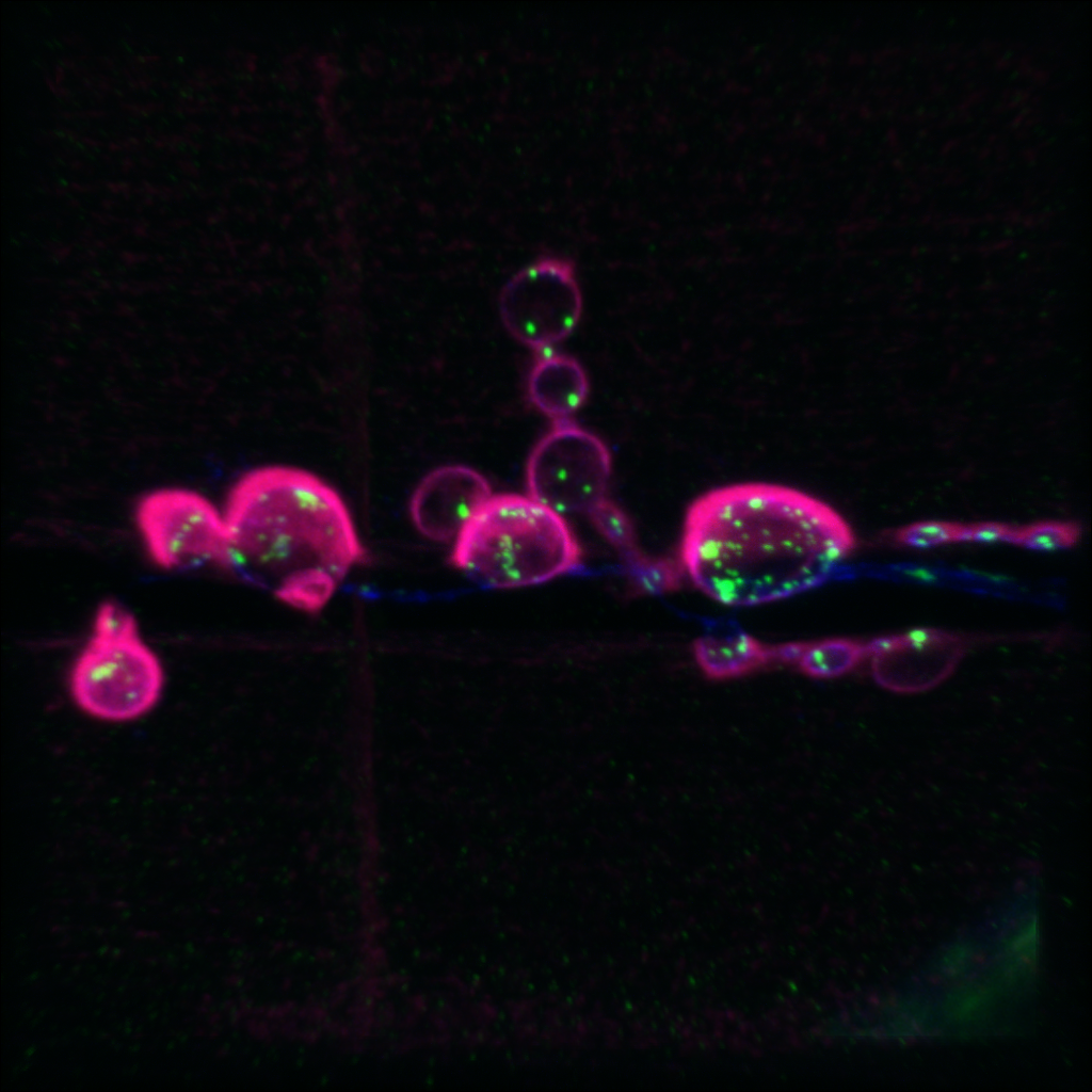 A Drosophila motor neuron expressing normal human ATAD3A gene. Neurons are labeled in blue. Boutons, areas of synapsis between neurons and muscles, are in red. Mitochondria are labeled in green. Courtesy of the Bellen Lab.