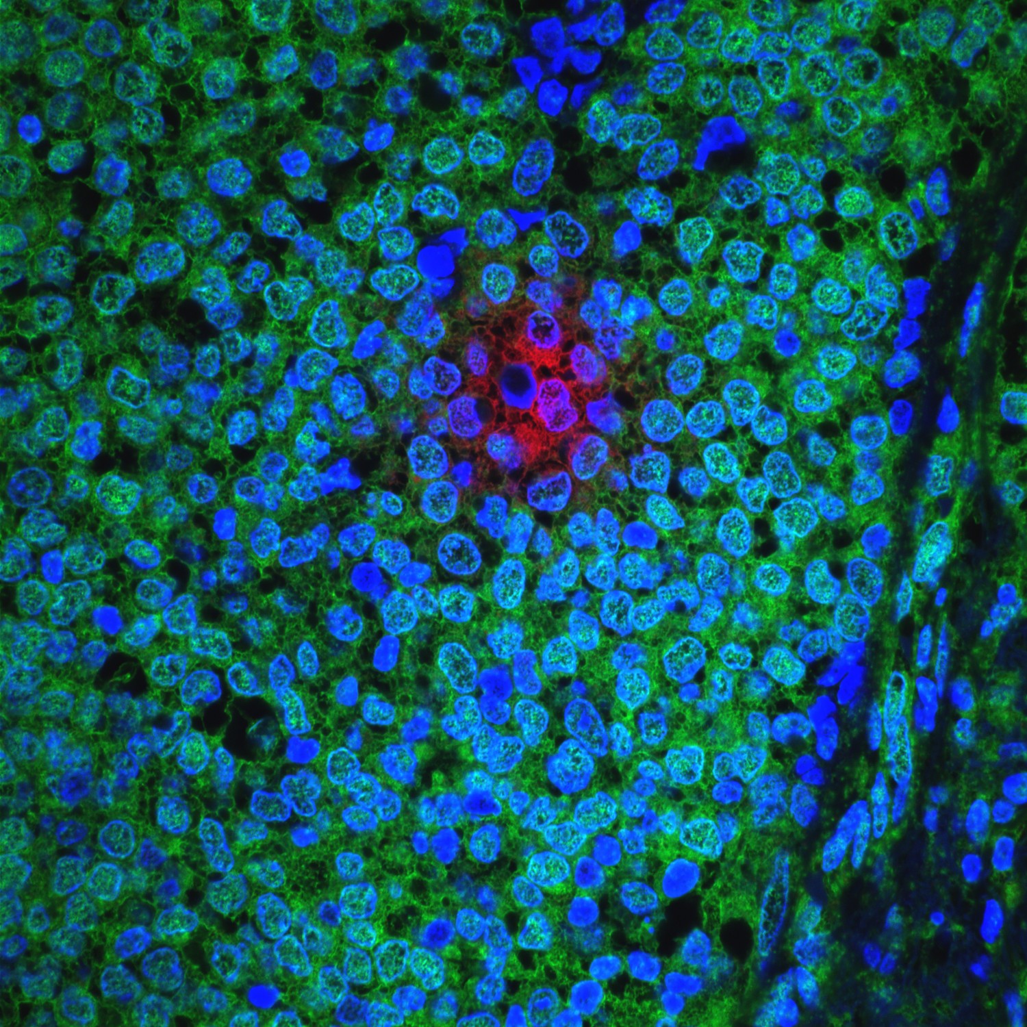 cluster of slow-cycling (AKT-low/Hes1-high) breast cancer cells (red) within a human ER+ primary breast tumor (cell nuclei in blue; rapidly cycling, AKT-high, cancer cells in green)