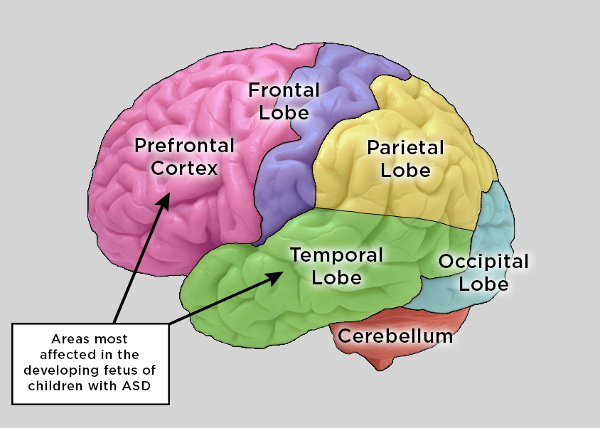 Autism Brain Affected