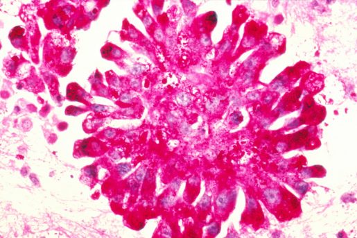 nci-ewing-sarcoma