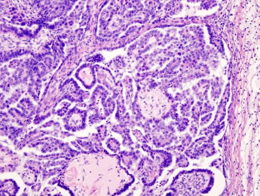 ovarian-cancer-image