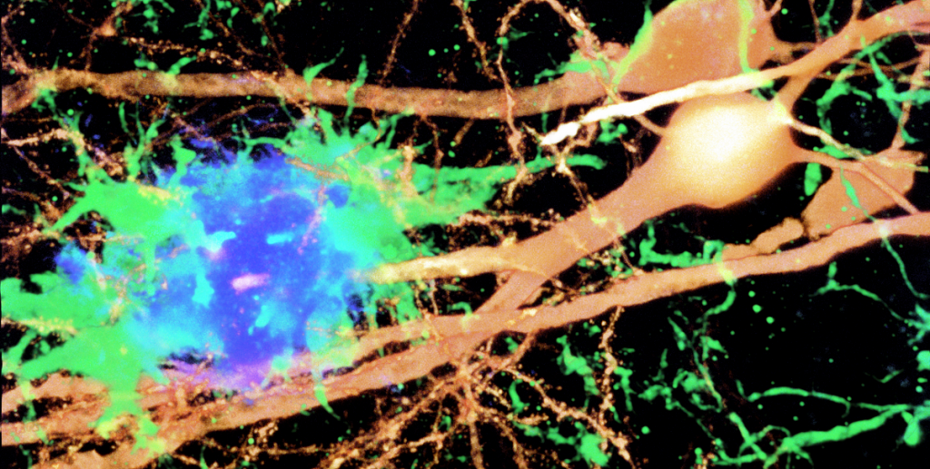 Connecting interferon, neuroinflammation and synapse loss in Alzheimer
