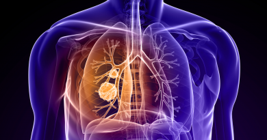 Lung cancer, illustrated here as round masses inside the lungs, the second most common cancer in both men and women.