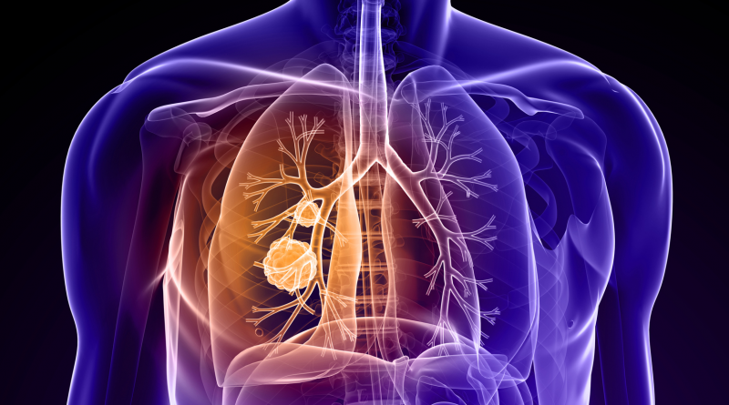 Lung cancer, illustrated here as round masses inside the lungs, the second most common cancer in both men and women.