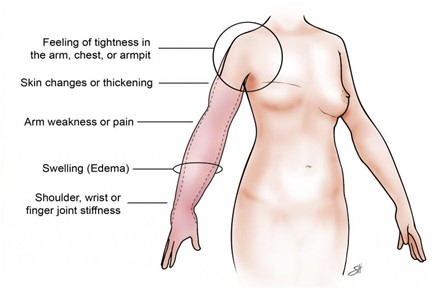 Lymphedema-image