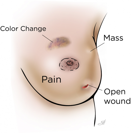 Mastitis (Breasts Infection) – Reasons, Signs & Remedies