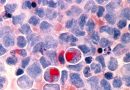 Scientists uncover nuclear droplets that link multiple leukemias, a potential new therapeutic target