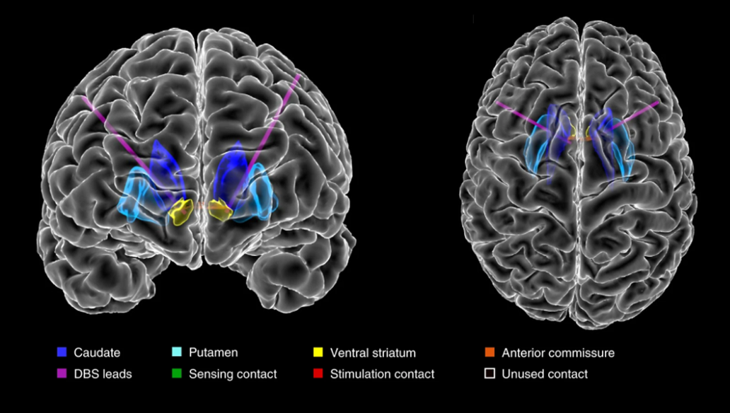 Obsessive Compulsive Disorder Brain