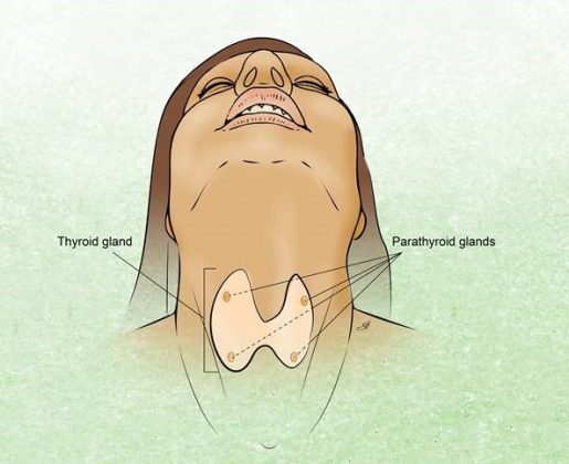 An illustration of a neck with the thyroid gland identified.