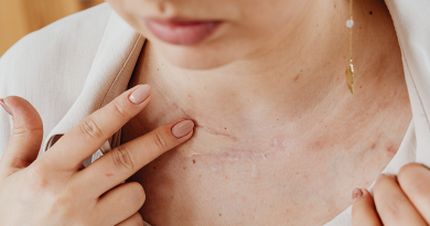 A person with their shirt pulled away from their neck as they massage a scar near the collarbone.