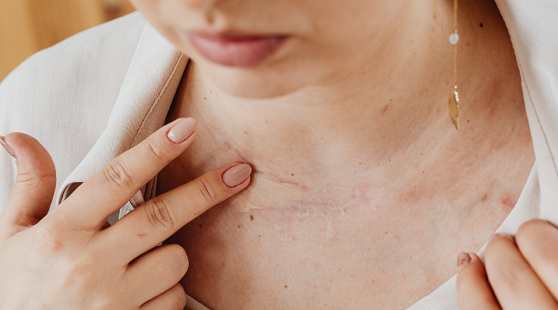 A person with their shirt pulled away from their neck as they massage a scar near the collarbone.