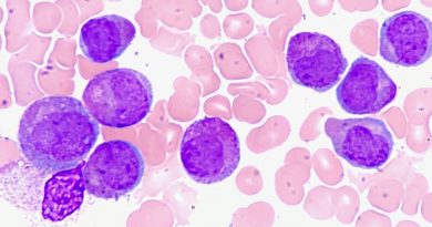 Microscopy image of purple leukemia cells amongst healthy pink cells