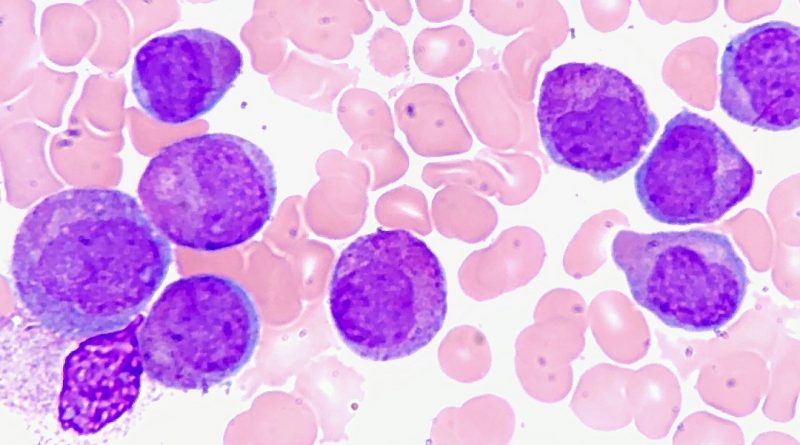 Microscopy image of purple leukemia cells amongst healthy pink cells