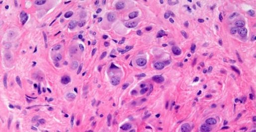 A microscopic view of prostate cancer. It appears as a field of hazy pink and white with splotches of purple indicating cancer cells.