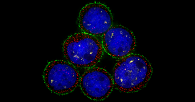 Microscopy-based image of human breast cancer cells, seen as blues circle with red and green circling around each.