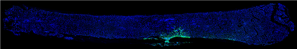 Dissemination of bone metastasis linked with bone remodeling