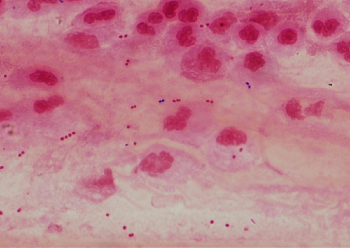 Understanding pneumonia Interview with Dr. Daniel M. Musher