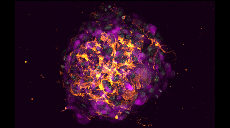 A purple and yellow 3D cellular model of a breast cancer organoid.