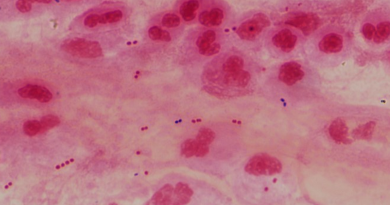 Microscopic view of a sputum sample showing many white blood cells and only Gram positive bacteria (small red dots) in pairs and chains.