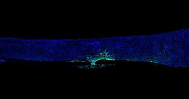 Metastatic cancer cells tagged with a green fluorescent protein reveal their localization around the site of a bone fracture in a mouse model.