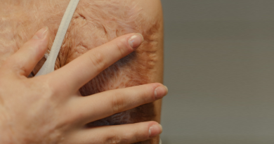 A person holding their handover an area of scar tissue.