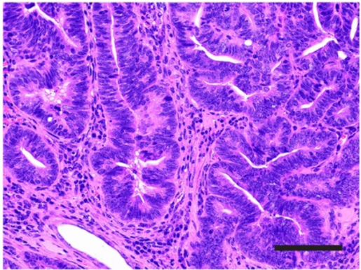 colon cancer cells under microscope