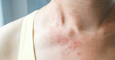 A person's neck with red blotches and distressed skin