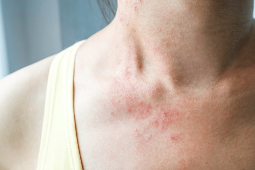 A person's neck with red blotches and distressed skin