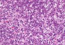 Novel combination therapy offers promising results for treatment-refractory hepatoblastoma