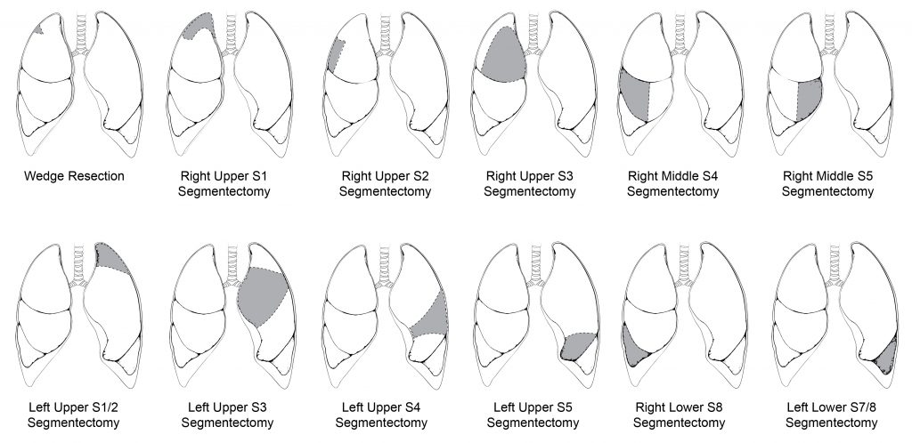 What Is Pulmonary Segmentectomy? - Baylor College Of Medicine Blog Network