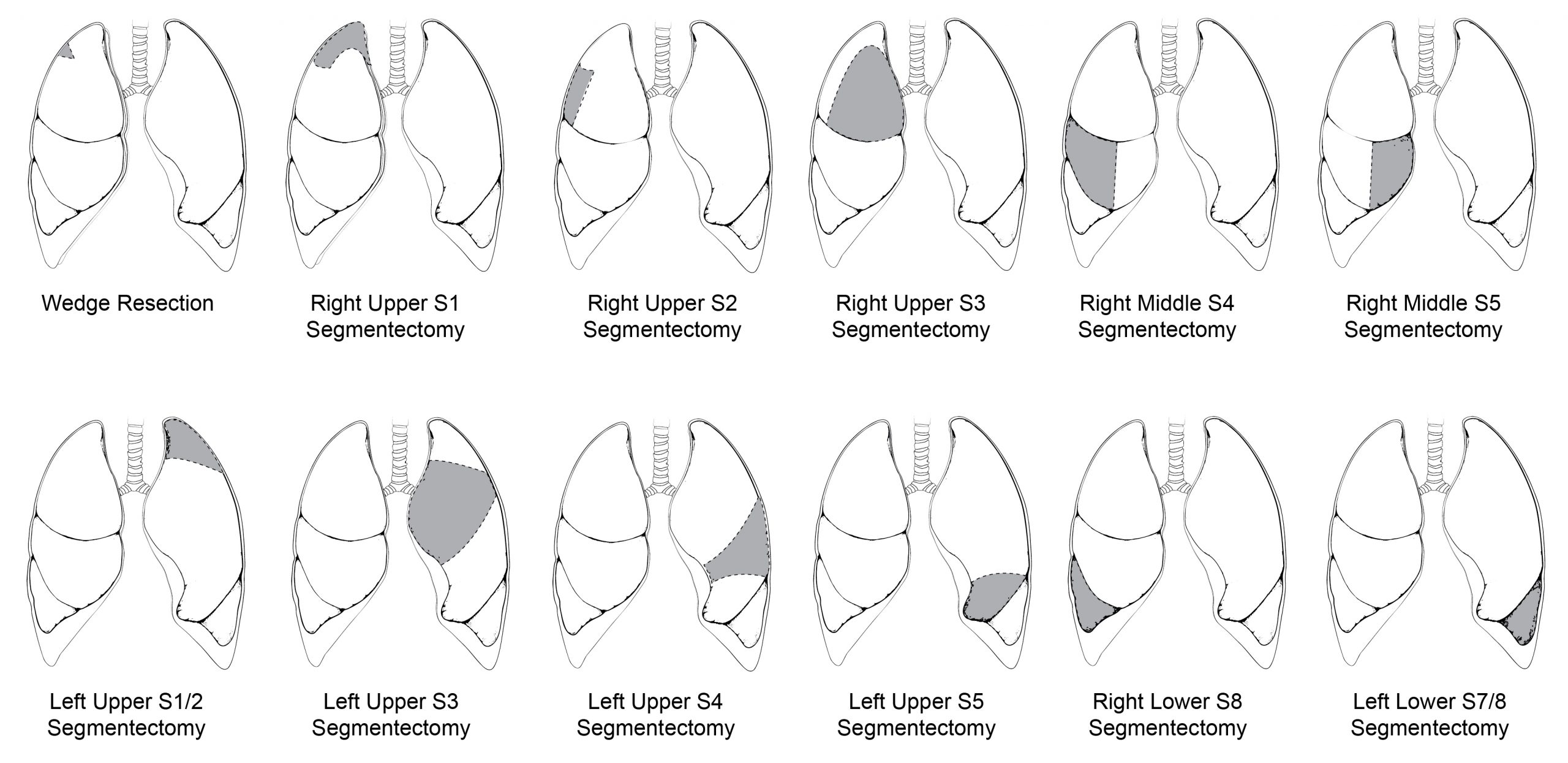 Illustration of 12 lungs showing different segmentectomy regions