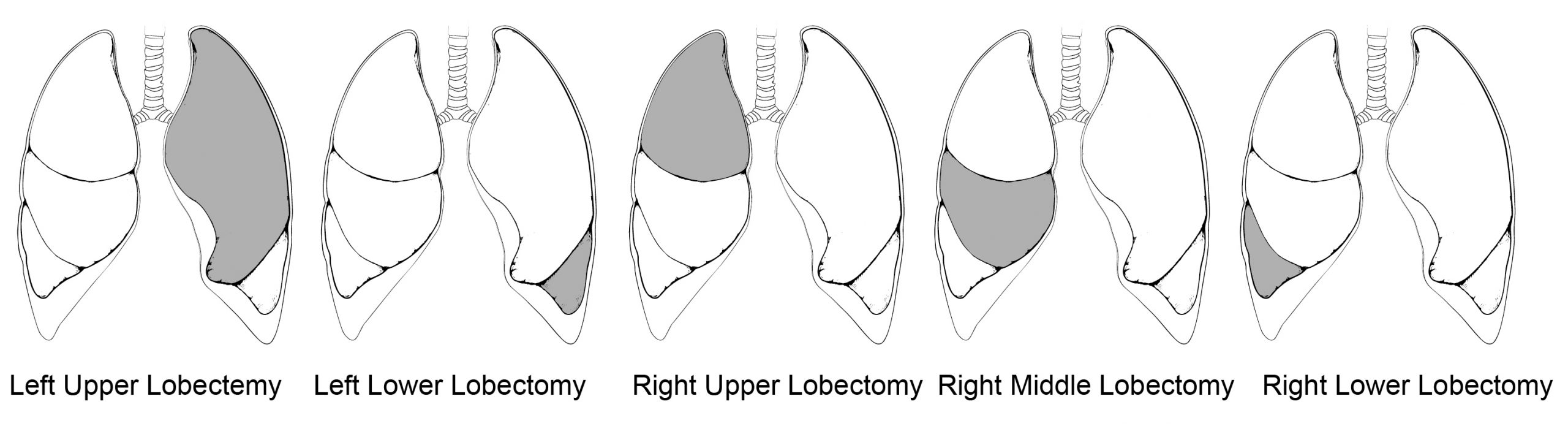Illustration of four sets of lungs, each showing a lobectemy in a different region of the lung.