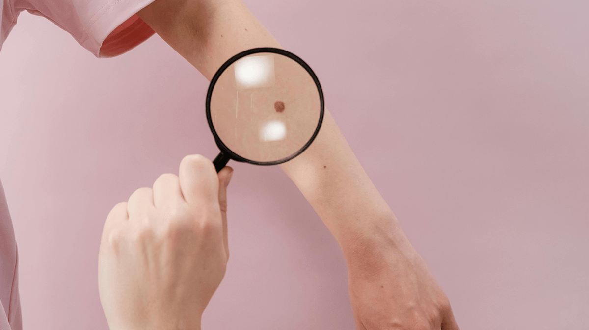 A mole on an arm as seen through a lens of a magnifying glass.