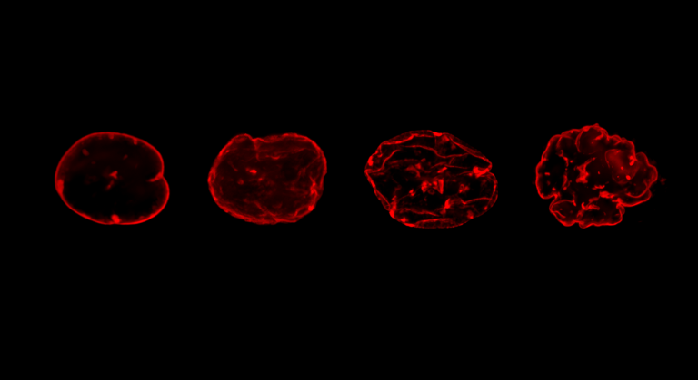 Overexpression of lamin A (red) causes structural changes to the cell nucleus that are associated with aging.