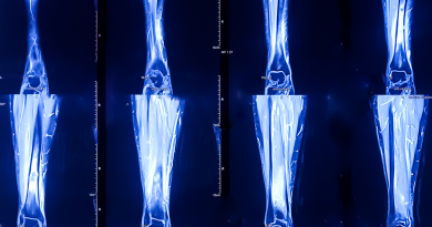 A series of x-rays of bones.