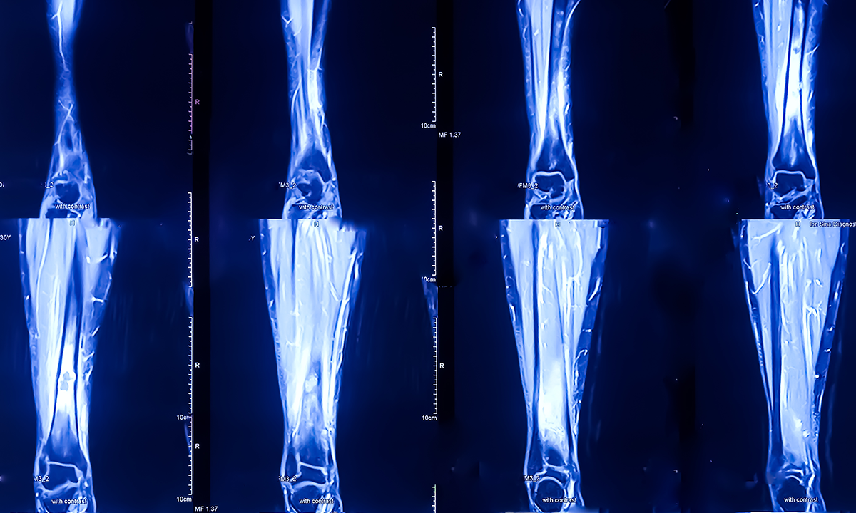 A series of x-rays of bones.