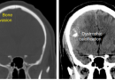 Recurrent meningiomas reveal insights into their aggressive behavior